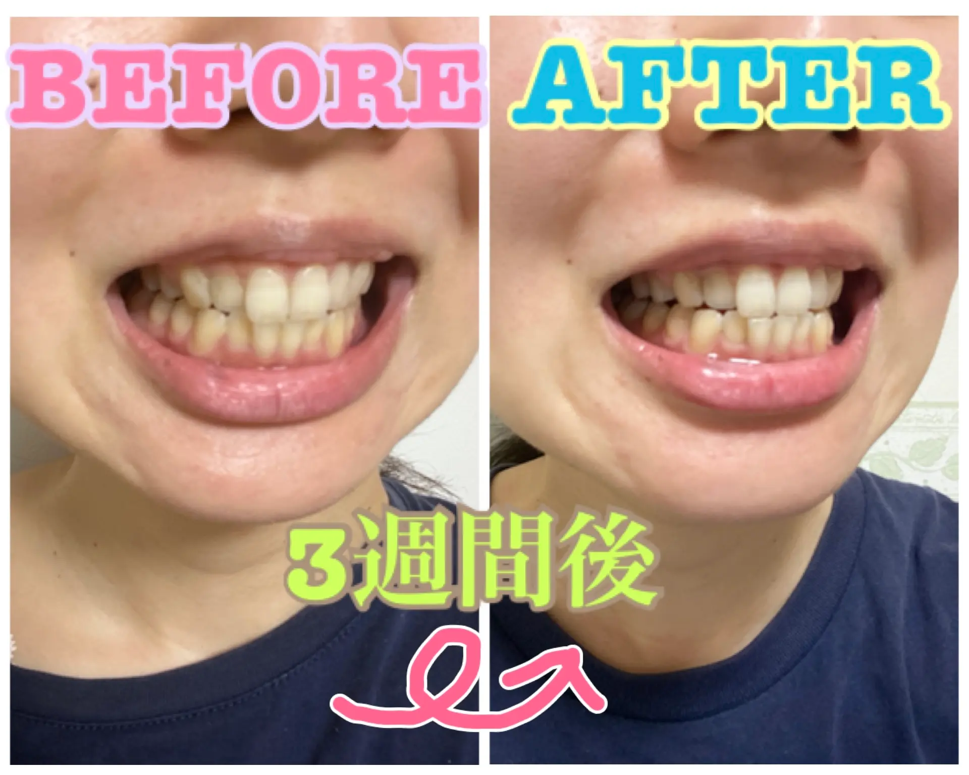 【おうちケア】毎日の歯ブラシで口腔ケアandホワイトニング!_5