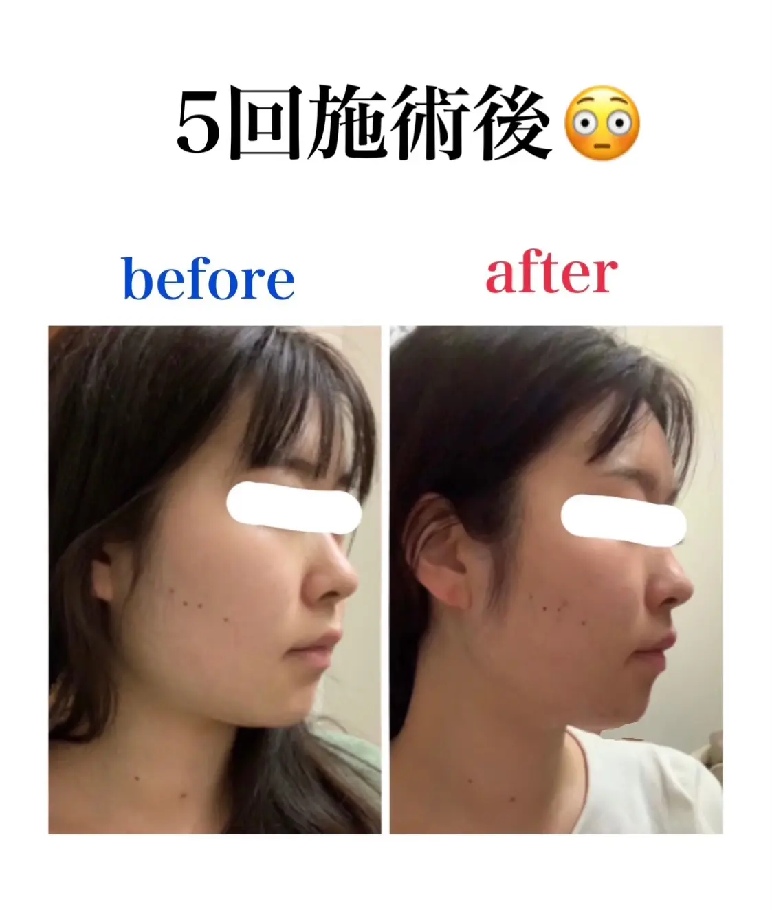 (**)顔が変わる!!美容鍼の魅力をご紹介‼︎_2