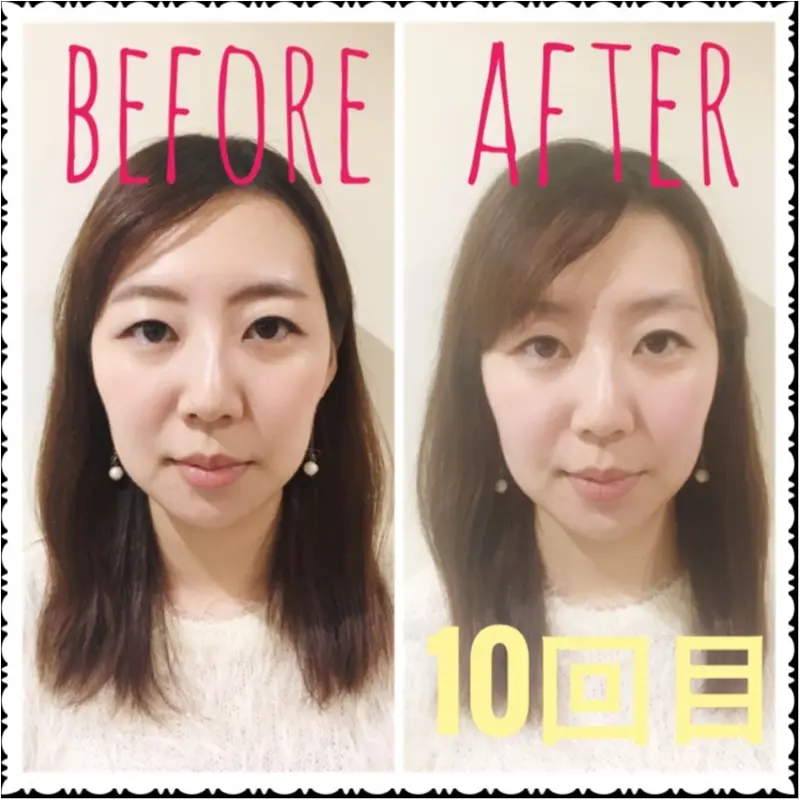 【小顔矯正】10回目を終えて見た目の変化にぎょぎょっ!!_6