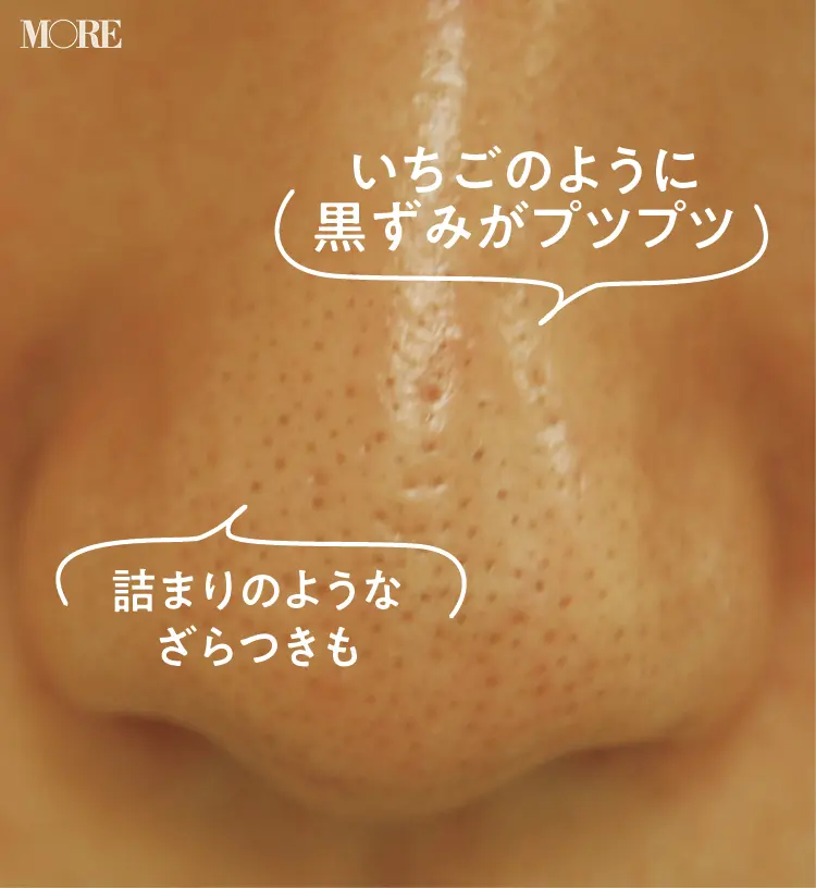 黒ずみ毛穴
