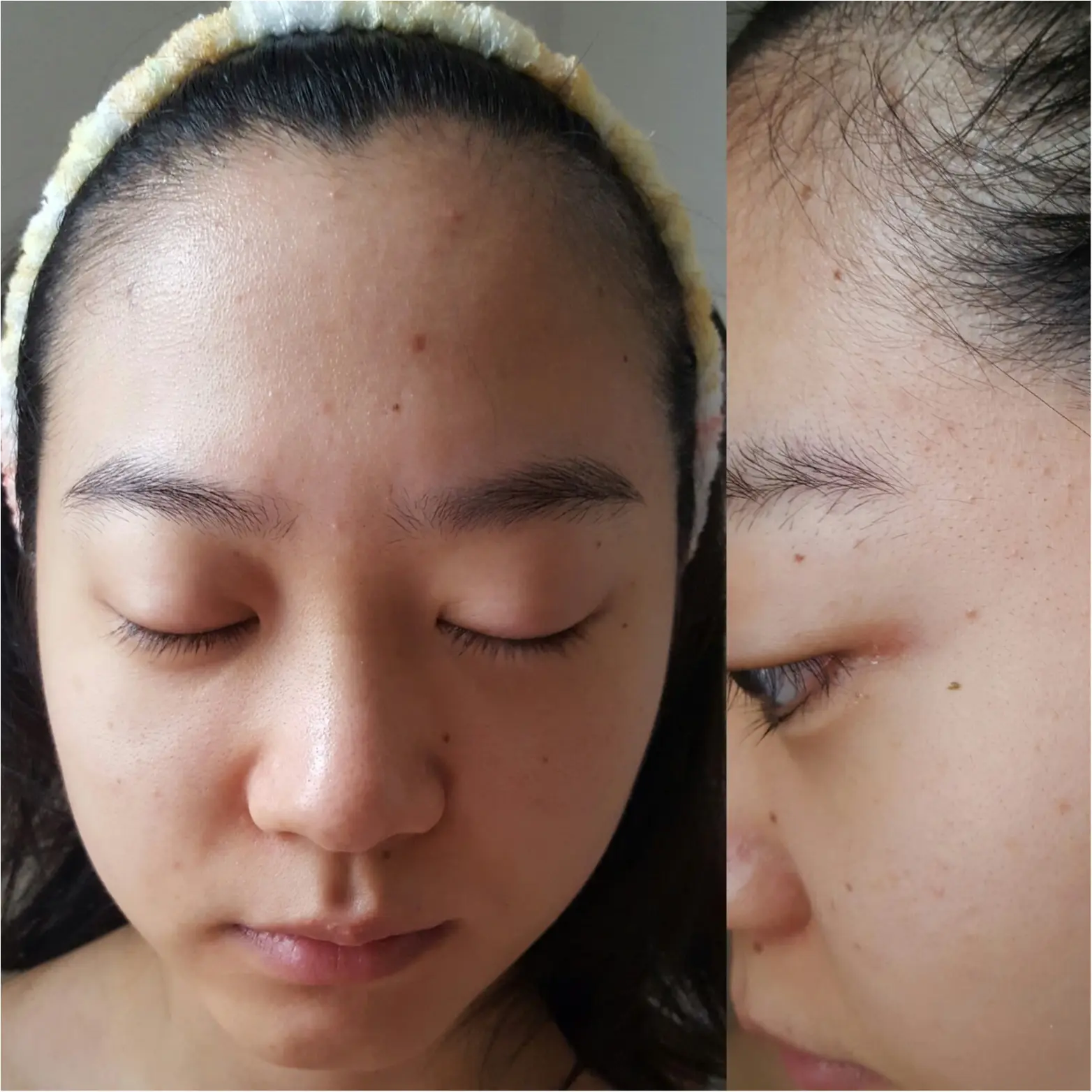 大人ニキビを治したい!と思ってたら必見☆ Before&After付き_4