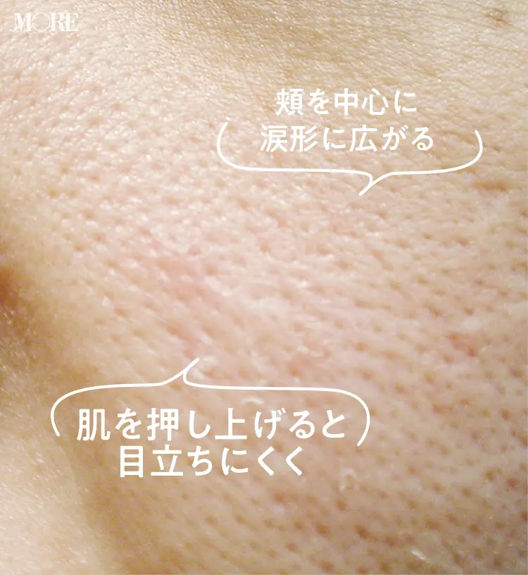 たるみ毛穴