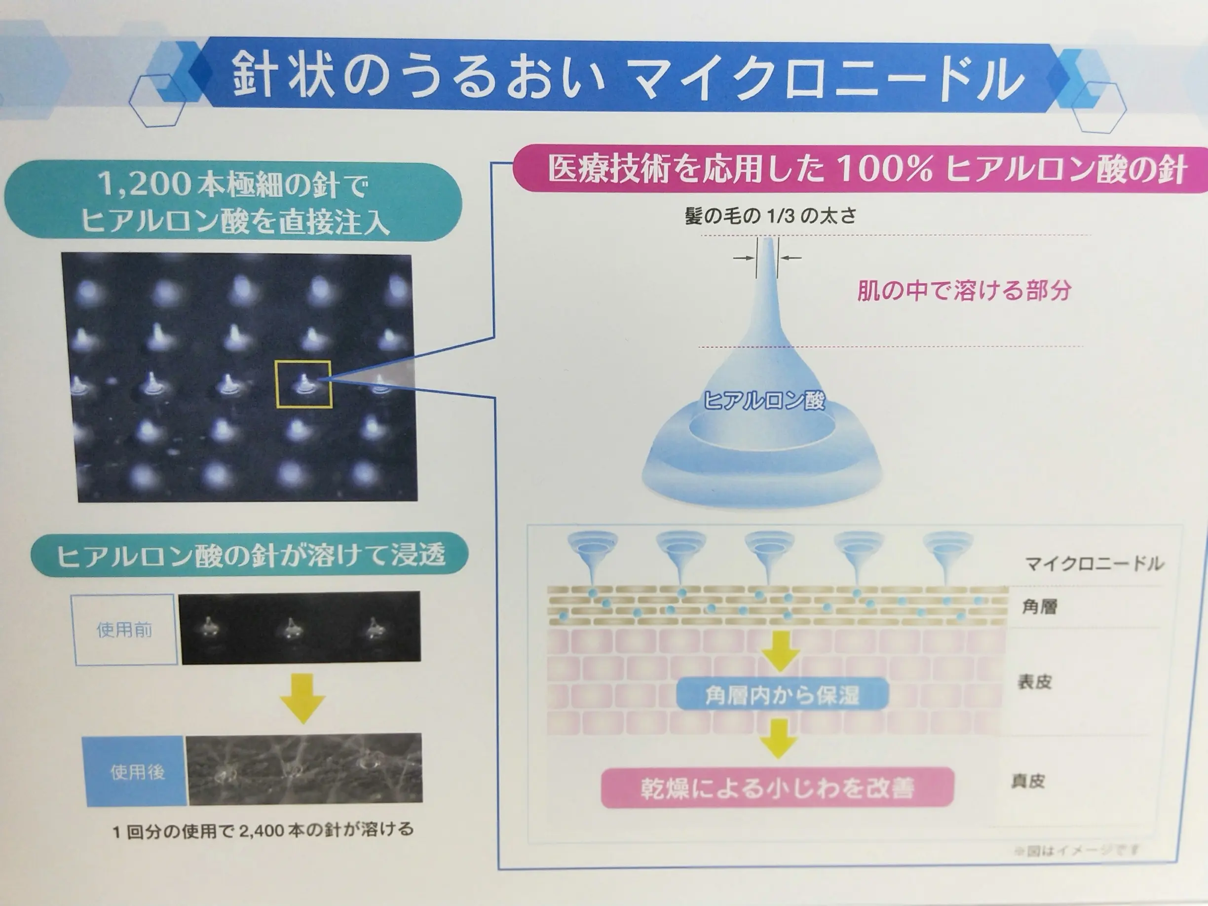 【期間限定ショップ】体験!針状のヒアルロン酸で自宅美容医療!?_2