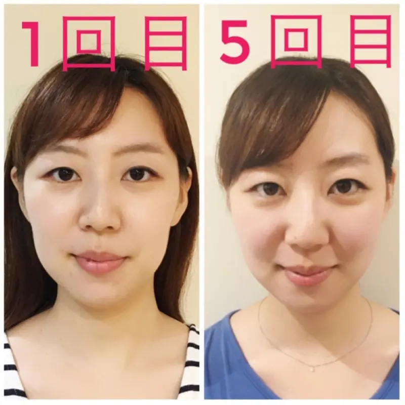 【小顔矯正】1回目と5回目を比較してみた。さぁ施術の効果はいかに!?_4