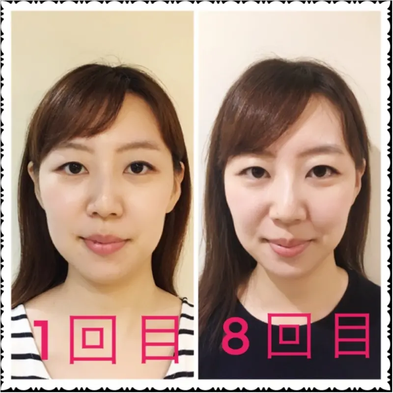 【小顔矯正】結構見た目でわかる!1回目と8回目を比較してみた_4