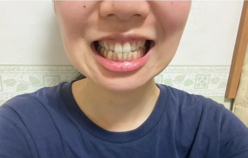 【おうちケア】毎日の歯ブラシで口腔ケアandホワイトニング!_6