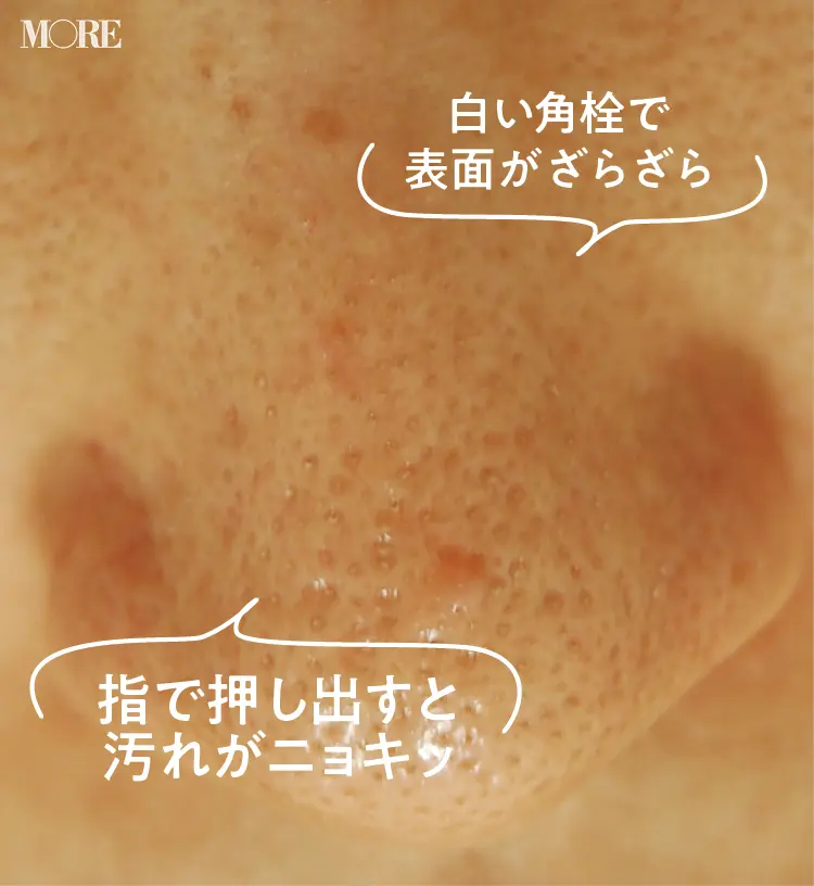 詰まり毛穴